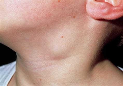 Close up Of Swollen Lymph Node In The Neck Of Boy ...
