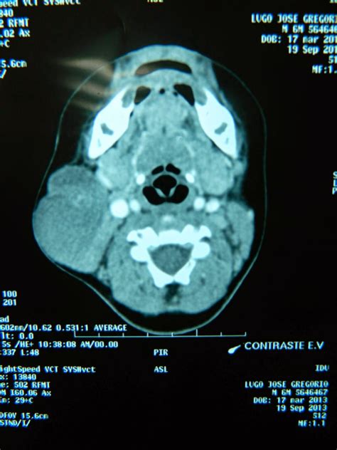 Cohen Cirugia Buco Maxilofacial: Adenoma Pleomorfo de glandula parotida