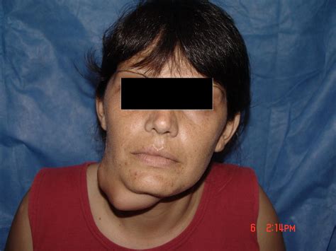 Cohen Cirugia Buco Maxilofacial: Adenoma Pleomorfo de Glandula Submaxilar