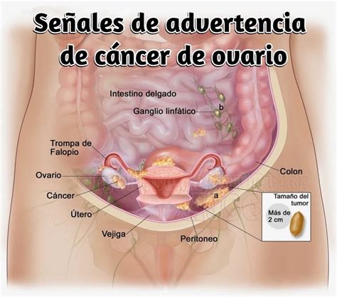 Colon Cancer: Cancer Colon Sintomas Mujeres