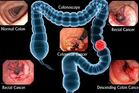 Colon cancer  colorectal cancer  Causes, Symptoms and ...