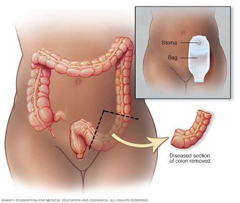 Colon cancer   Diagnosis and treatment   Mayo Clinic