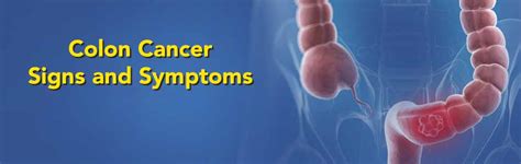 Colon Cancer Early Signs