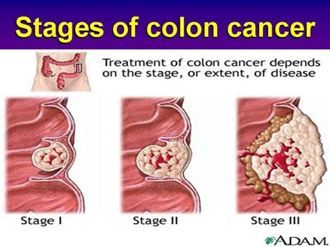 Colon Cancer   edmarkedren