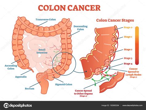 Colon cancer médica vector ilustración esquema diagrama ...