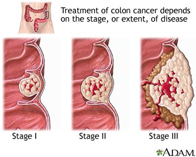 Colon cancer: MedlinePlus Medical Encyclopedia