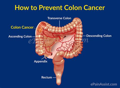 Colon Cancer or Cancer of the Colon|Survival Rate ...