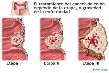 Colon Cancer: Sintomas Del Cancer De Colon