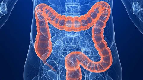 Colon cancer   stages, symptoms, causes and treatment
