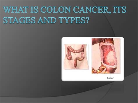 Colon cancer, stages,types