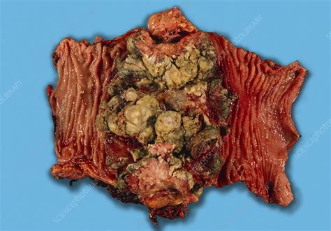 Colon cancer   Stock Image   M131/0703   Science Photo Library