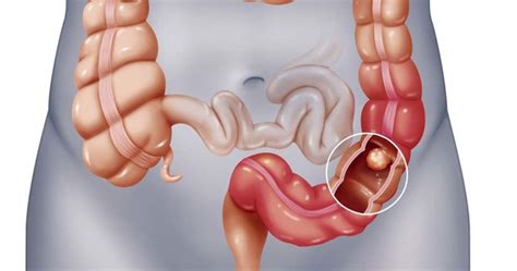 Colon Cancer Survivors Are 42% Less Likely To Die If They ...