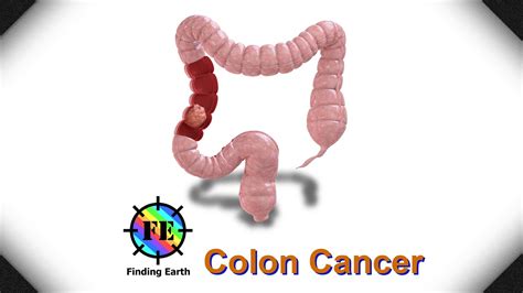 Colon Cancer   Symptom, Causes & Diagnosis  Finding Earth ...