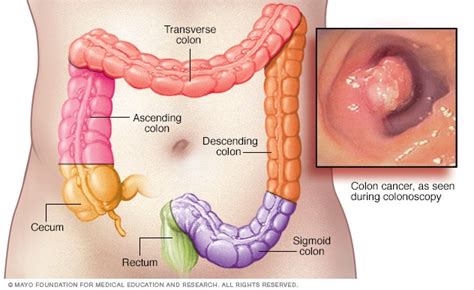 Colon cancer   Symptoms and causes   Mayo Clinic