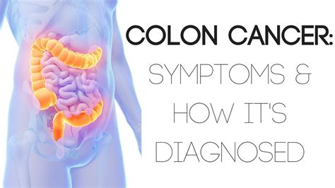 Colon Cancer: Symptoms and How it s Diagnosed   YouTube