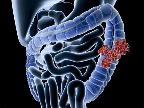Colon cancer: Symptoms, causes, and treatment