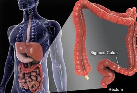 Colon Cancer: Symptoms, Signs, Screening, Stages