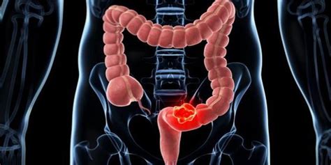 Colon cancer: These are the warning symptoms and so you ...