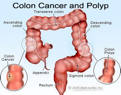 Colon Cancer Treatment, Symptoms, Prevention & Survival Rate