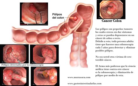 Colonoscopia   Gastroenterologo El Salvador ...