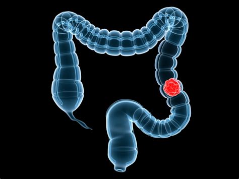 Colorectal Cancer: Causes, Symptoms, and Treatment ...