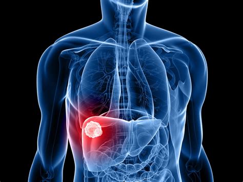 Colorectal Cancer Metastasis Associated With Liver ...