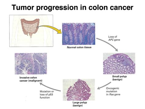 Colorectal Cancer: new Evidence about the predictive Value ...