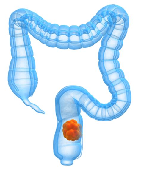 Colorectal cancer   the warning signs | Bowel Surgery London