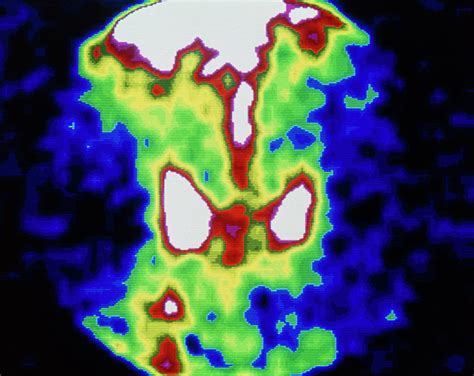 Coloured Gamma Scan Of Metastatic Cancer In Femur ...