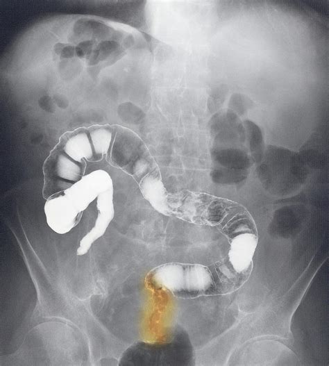 Coloured X ray Of The Colon Showing Rectal Cancer ...