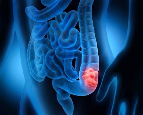 Combatir el cáncer de colon: prevenir y diagnóstico precoz ...