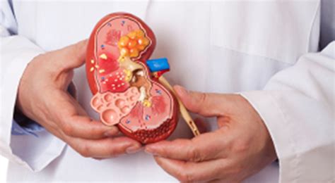 Combination Therapy Is Promising for Kidney Cancer, Expert ...