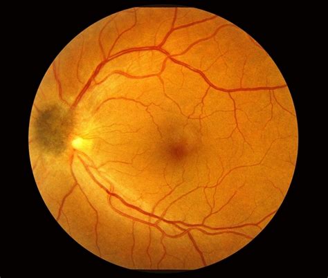 Combined Hamartoma of the Retinal Pigment Epithelium Case 1   Retina ...