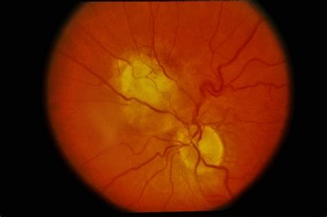 Combined Retinal & RPE Hamartoma   Retina Image Bank