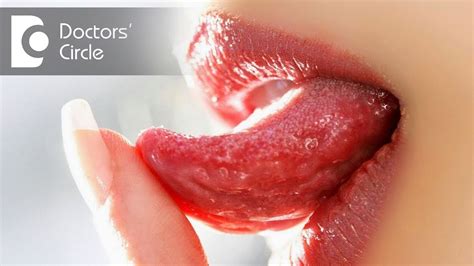 Common causes of ulcers on tongue in your 30s   Dr ...