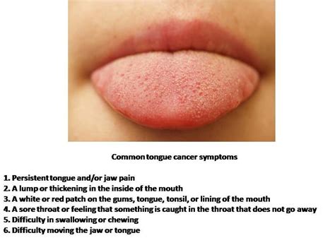 Common ‪#‎tongue‬ ‪#‎cancer‬ ‪#‎symptoms‬ Persistent ...