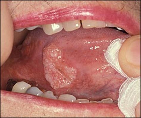 Common Tongue Conditions in Primary Care   American Family ...
