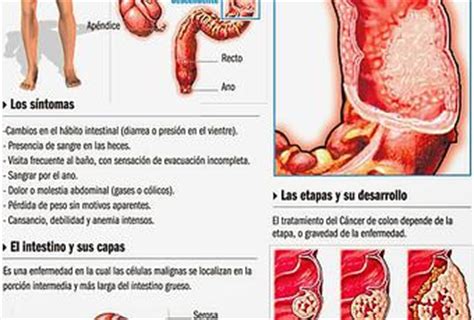 Cómo afecta el cáncer de colon #Infografía #Salud #Cáncer ...