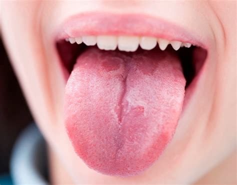Como curar las ampollas en la lengua