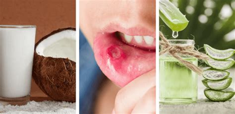 Cómo curar las llagas de la boca de forma rápida y natural | Soluciones ...