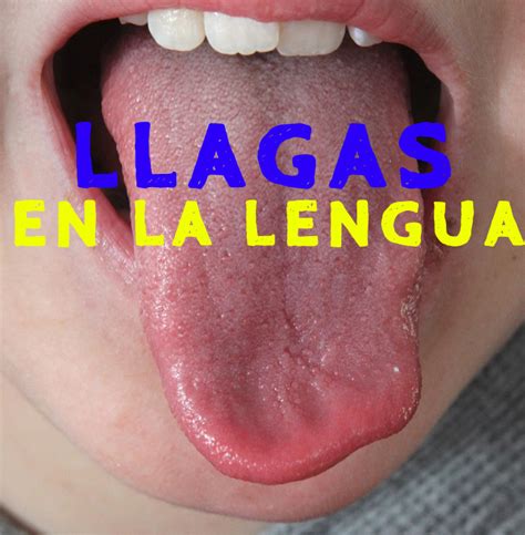 Cómo curar las llagas de la lengua: 13 formas de quitarlas | La Guía de ...