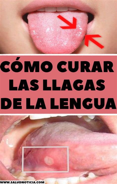 Cómo curar las llagas de la lengua | Medical