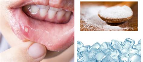 ¿Cómo curar las llagas que aparecen en la boca? | Blog