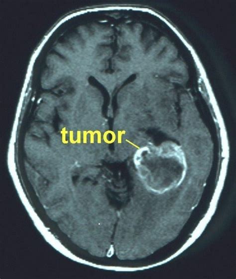 Como detectar un tumor cerebral   Taringa!