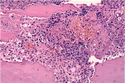 Cómo el cáncer de próstata evade al sistema inmune   BiotechMN