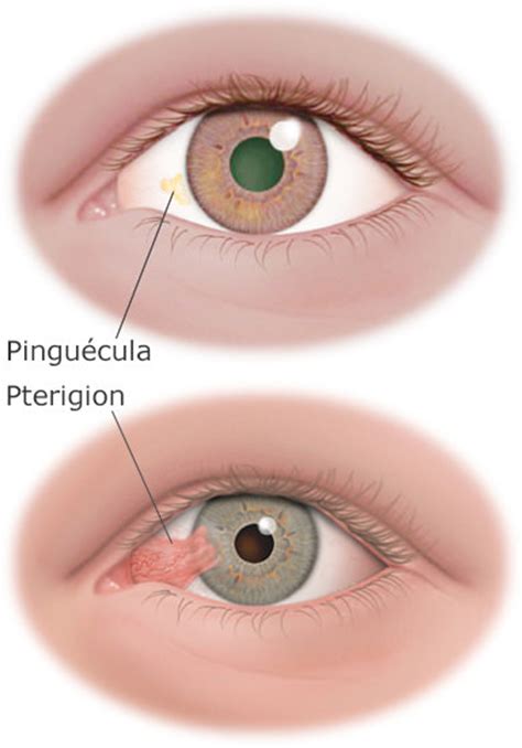 Cómo eliminar el pterigion de los ojos