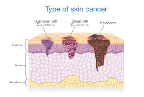 ¿Cómo es la evolución del cáncer de piel? — Mejor con Salud