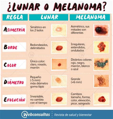 Cómo identificar un melanoma: métodos, pruebas y localización