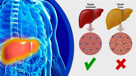 Cómo limpiar el hígado graso   8 Jugos 100% Efectivos