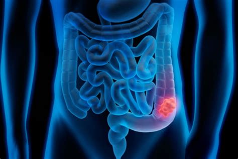 ¿Cómo prevenir el cáncer de colon? – La Bola Caliente